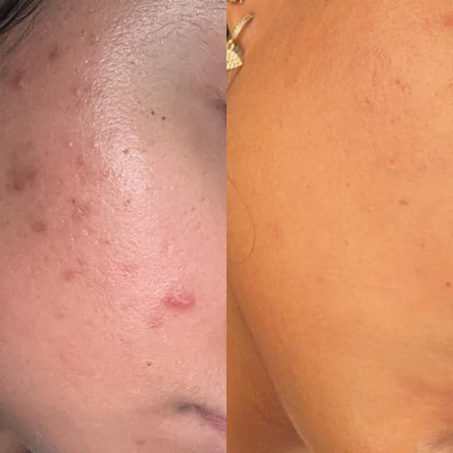 Skin Refinement Program at Taiane Alvarenga Concept in Woburn, MA